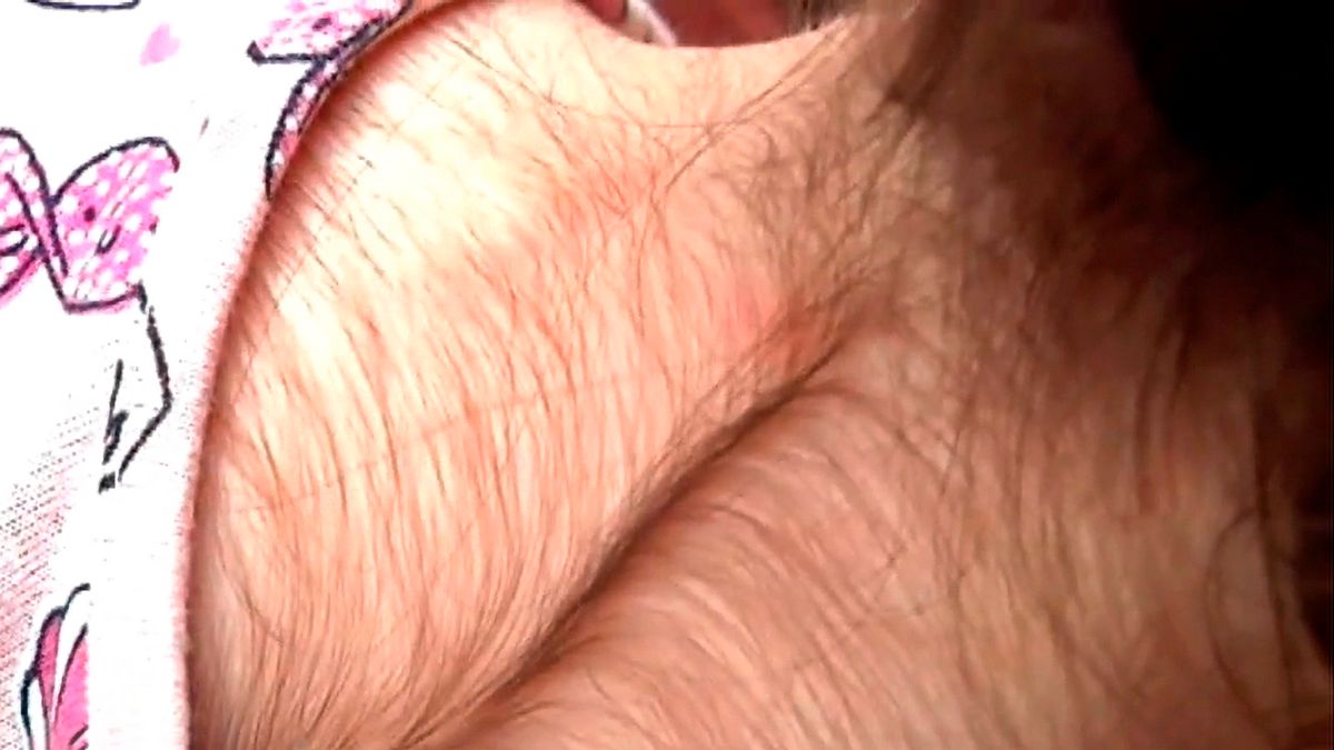 Erro médico faz pelos crescerem no corpo inteiro de crianças na Espanha