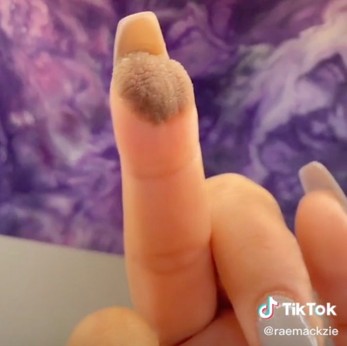 Mulher revela o que há por trás do estranho enxerto de pele feito em seu dedo