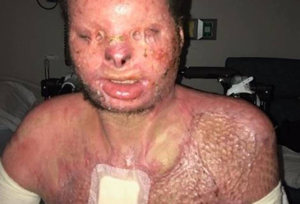 Homem recebe novos rosto e mãos em transplante raro
